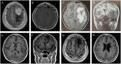 Case report: Successful treatment of a patient with relapsed/refractory primary central nervous system lymphoma with thiotepa-based induction, autologous stem cell transplantation and maintenance